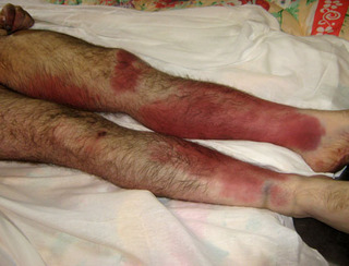 Следы побоев на теле Тархана Картоева. Фото предоставлено родственниками