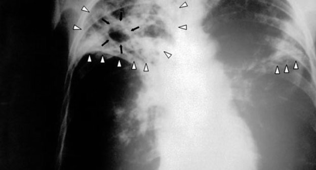 Рентгенограмма органов грудной клетки больного туберкулёзом. Фото с сайта http://ru.wikipedia.org