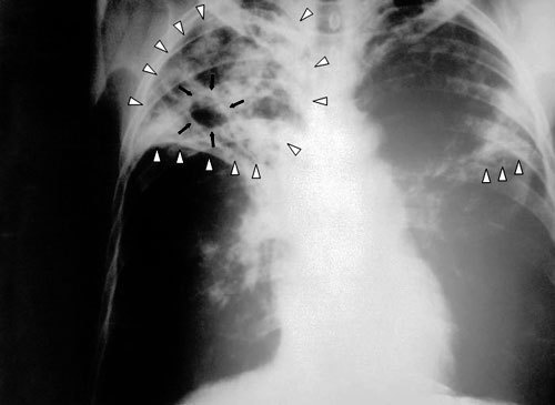 Рентгенограмма органов грудной клетки больного туберкулёзом. Фото с сайта http://ru.wikipedia.org