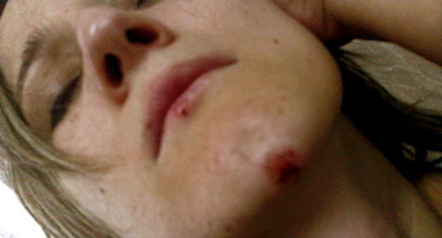 Сапият Магомедова после избиения 17 июля 2010 года. Фото предоставлено Правозащитным центром "Мемориал"