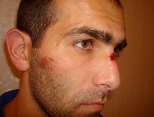 Малик Аппаев со следами избиений на лице, после освобождения из Эльбрусского РОВД. Фото с сайта Правозащитного центра "Мемориал" (www.memo.ru)