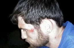 Побои на лице у дальнобойщика Рустама Малламагомедова. 23 августа 2016 г. Фото Елены Филипповой https://www.facebook.com/photo.php?fbid=1562448027396598&set=ecnf.100008942464217&type=3&theater