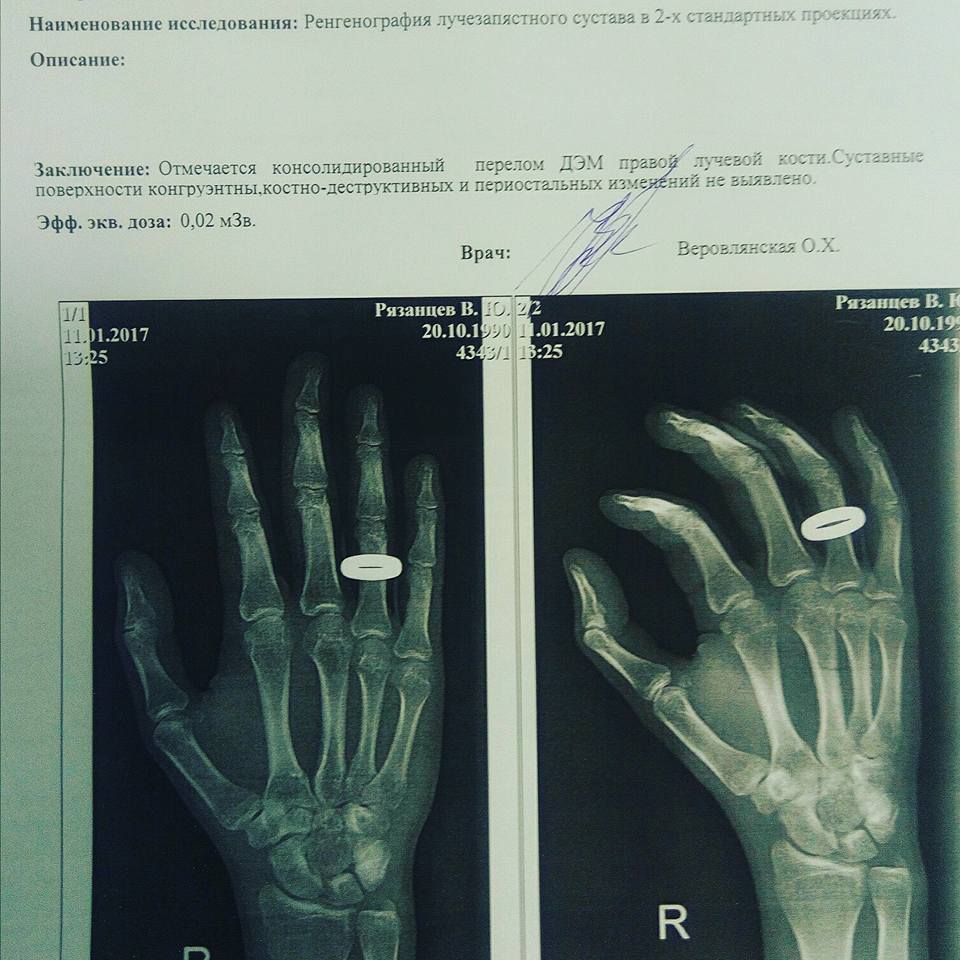 В своем заключении врачи отметили, что у Рязанцева диагностирован перелом. Фото Владислава Рязанцева. 
