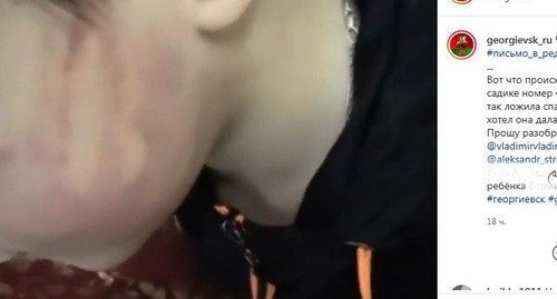 След от пощечины на лице ребенка. Скриншот видео https://www.instagram.com/georgievsk_ru/